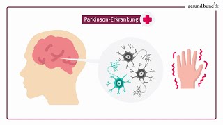 Was ist die ParkinsonErkrankung [upl. by Odraude]