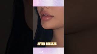 Lip Filler Treatment results in BandraMumbai [upl. by Arac]