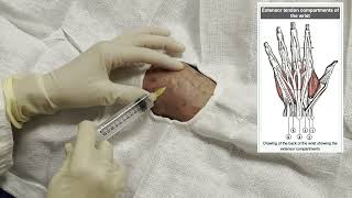 Wrist Arthrocentesis [upl. by Edia]