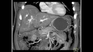 Abdomen Liver CT demonstrates a hemangioma of the liver because of the fatty infiltration8 of 10 [upl. by Alarice]