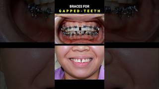 BRACES FOR GAPPED TEETH 32 MONTHS DURATION braces orthodontist dentist [upl. by Endaira]