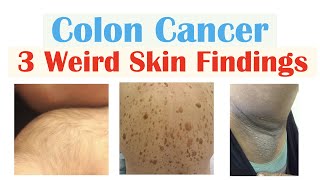 3 Weird Signs of Colon Cancer Found on the Skin [upl. by Anabahs]