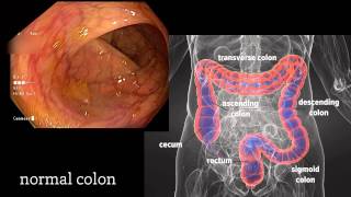 Colonoscopy A Journey Though the Colon and Removal of Polyps [upl. by Beaufert858]