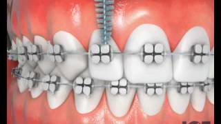 Interproximal Brush With Braces [upl. by Hsak]