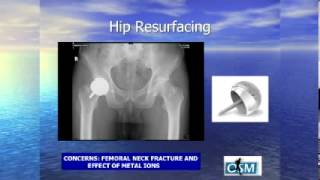 Almost Pain Free Joint Replacement Peter Boone MD and David Lo MD St Vincents Bpt CT [upl. by Anyr]