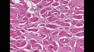 Histopathology Heart Amyloidosis [upl. by Natalina802]