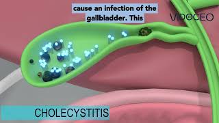 Acute cholecystitis explained [upl. by Herculie]