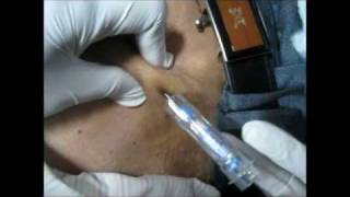 How To Give Goserelin Injection By Subcutaneous Mode [upl. by Euhsoj]