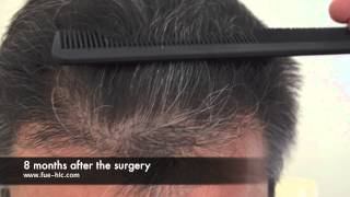 FUE Hair Transplant Hairline Clinic  DrOzgur 2500 GRAFTS DENSE PACKING 8 MONTHS LATER [upl. by Jemmie]