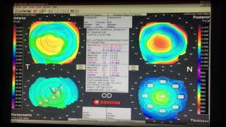 Topografía Corneal [upl. by Silera]