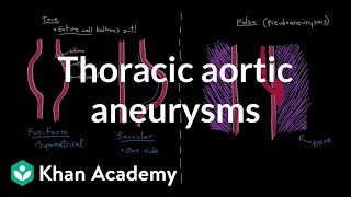 Thoracic aortic aneurysms  Circulatory System and Disease  NCLEXRN  Khan Academy [upl. by Mehs]