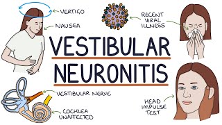 Understanding Vestibular Neuronitis [upl. by Odlanyer556]