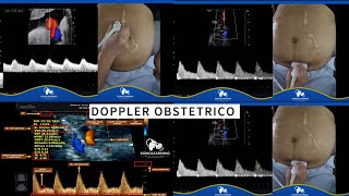 TECNICA DOPPLER OBSTETRICO BASICO [upl. by Gipson]