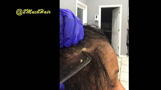 Part 4 Dermal Cleanse Scalp Scratching Flakes Removed 1 [upl. by Naloj]