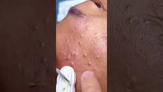 Huge Blackhead Extraction Extremely Satisfying [upl. by Suqram]