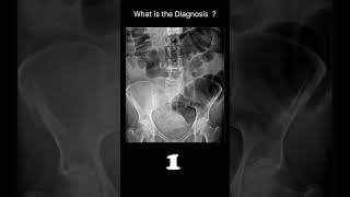 Large bowel obstruction Abdominal XrayAbnormalities Largebowel obstruction68radiologychannel007 [upl. by Leff]