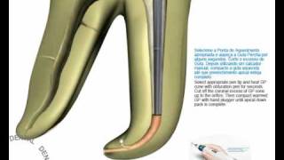 Sistema de obturación con gutapercha termoplastificada [upl. by Osnohpla]