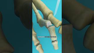 What is Hammer Toe and How to Fix It shorts viralvideo  Creativelearning3d [upl. by Etac]