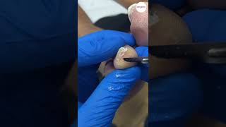 Tip of toe callus debridement [upl. by Windham]