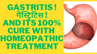 GASTRITIS  BEST HOMEOPATHy MEDICINE FOR GASTRITIS [upl. by Lacsap740]