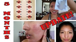 5 Months on Isotretinoin Accutane  Update amp Blood Tests [upl. by Jovitta]