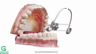 Green leaf orthodontics how palatal expander works dentist dental teeth health crossbite [upl. by Heymann]