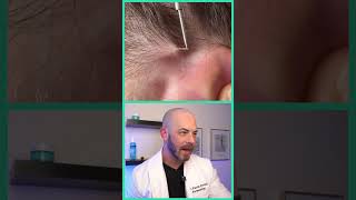 Doctor reacts to impacted ingrown hair removal dermreacts doctorreacts ingrownhair [upl. by Inirt]