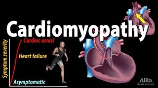 Cardiomyopathy animation [upl. by Eugenio]