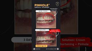 Addressing Gum Recession amp Crown Length with Pinhole® pinhole gumrecession gumrestoration [upl. by Noicpesnoc]