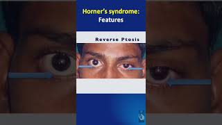 Shorts  81 Features of Horners syndrome in Brachial plexus injuries [upl. by Obelia]