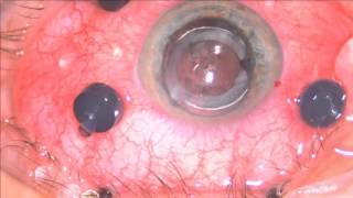 Oxane HD removal with epiretinal membrane peeling Live DrMishev [upl. by Cornish538]