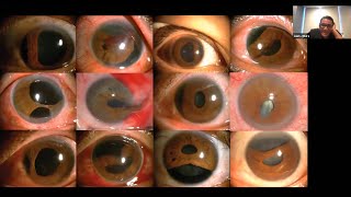 Trauma Ocular Penetrante Córnea Iris y Cristalino [upl. by Assirol]