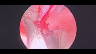 Polyp arising from margin of maxillary sinus opening  Dr Hitesh Patel [upl. by Haydon]