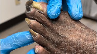 Complete Feet Makeover Medical Pedicure [upl. by Aala846]