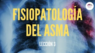 3 FISIOPATOLOGÍA DEL ASMA FISIOPATOLOGÍA RESPIRATORIA [upl. by Enilorak]