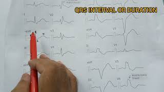 QRS INTERVAL OR DURATION OR TIME [upl. by Enahc]