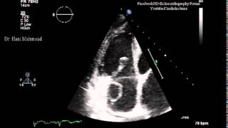 Right Atrial Thrombus [upl. by Almond]