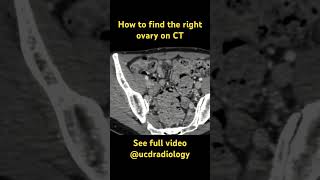 Right ovary on CT radiologyresident medicine radres doctor medicalstudent radiology [upl. by Oivlis]