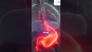 Complications of Peptic Ulcer [upl. by Olrac535]