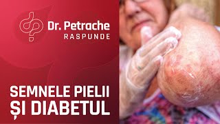 SEMNE DE DIABET CE APAR PE PIELE [upl. by Anitnauq565]