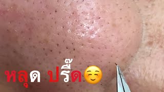 กดสิว blackheads filaments on nose remove with tweezers [upl. by Eneleuqcaj]