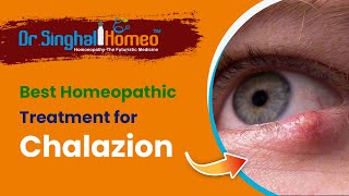 Best Homeopathic Treatment for Chalazion  Dr Singhal Homeo [upl. by Noda949]