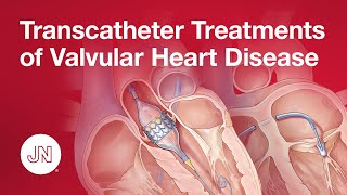 Transcatheter Treatments of Valvular Heart Disease [upl. by Nerb]