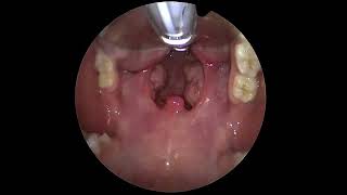 The Throat Exposure For Tonsillectomy Surgery [upl. by Atse]