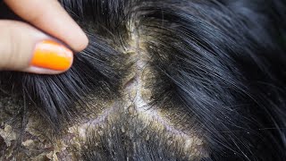 dandruff removal huge flakes scratching on head13 [upl. by Lindsay]