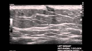 Digital Breast Tomosynthesis calcifications lymph nodes and stable masses [upl. by Anelas]