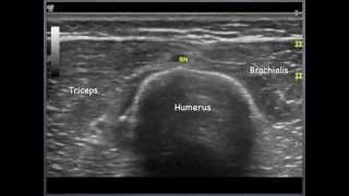 Radial Nerve  humerus to elbow Sonoanatomy  QMH AED Ultrasound Casebook 2013 Video 7 [upl. by Atnwahs365]