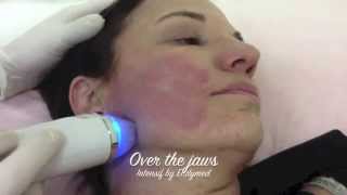 Intensif RF MicroNeedling from EndyMed [upl. by Maxine720]