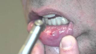 Fotona Laser Mucocele removal Boynton Laser Dental [upl. by Bury]