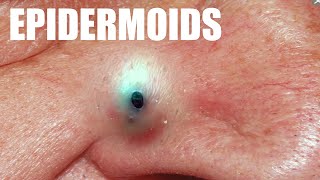 OOZY Epidermoid Cysts [upl. by Akital]